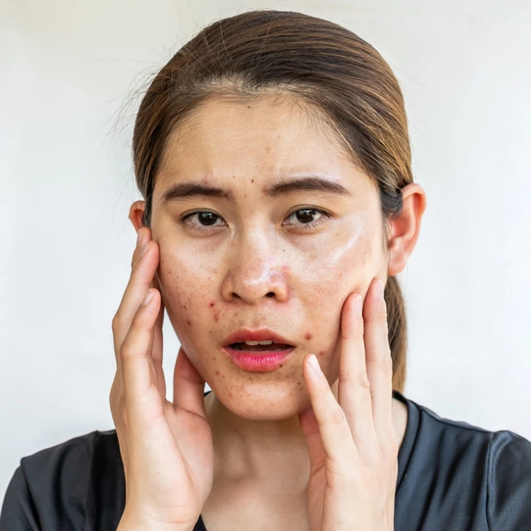 Da Dầu Mụn Có Nên Dùng Kem Chống Nắng?