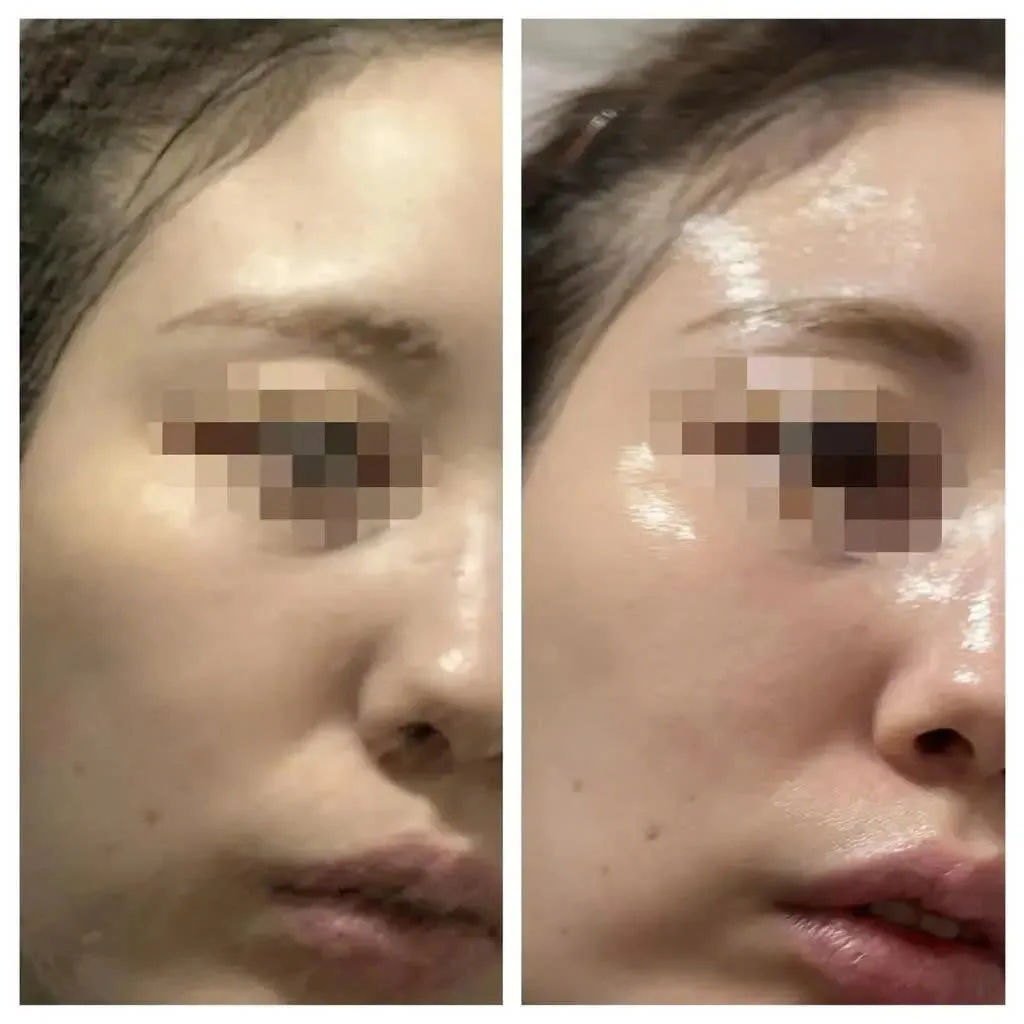 Before after khách hàng 3